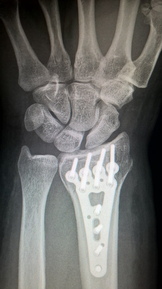 xray titanium plate